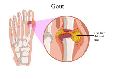 Biến chứng nguy hiểm của bệnh Gout (Gút)