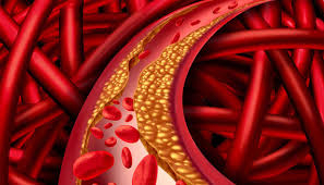 Cholesterol máu cao: Tăng nguy cơ mắc bệnh tim